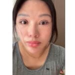Viral di China, Perempuan Ini Tak Bisa Tidur dengan Mata Tertutup Akibat Oplas Gagal