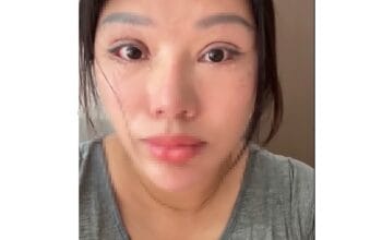 Viral di China, Perempuan Ini Tak Bisa Tidur dengan Mata Tertutup Akibat Oplas Gagal