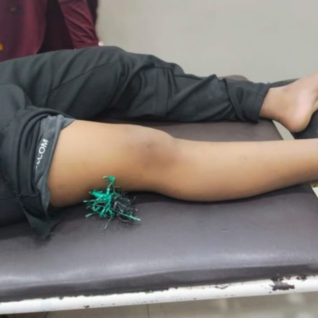 Pelajar di Takalar Jadi Korban Busur, Paha Tertancap Anak Panah