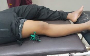 Pelajar di Takalar Jadi Korban Busur, Paha Tertancap Anak Panah